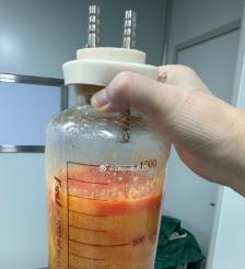 滨州水动力吸脂手术要做多久？